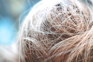 Photo Hair Loss Myths