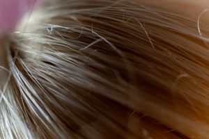 Photo Vitamin Deficiency Hair Loss